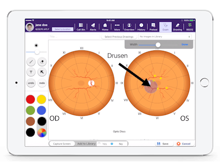 a picture of drusen in Drawing Board, a feature in EMA ophthalmology EHR