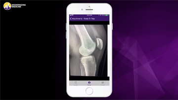 PocketEMA™ for Orthopedics