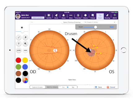 a picture of drusen in Drawing Board, a feature in EMA ophthalmology EHR a picture of drusen in Drawing Board, a feature in EMA ophthalmology EHR