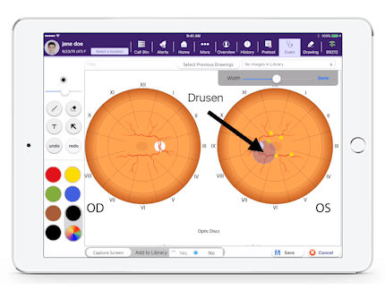 a picture of drusen in Drawing Board, a feature in EMA ophthalmology EHR