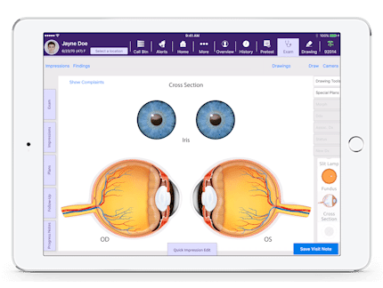 a cross section of left and right eyes in Interactive Anatomical Atlas, a feature of EMA, an ophthalmology software