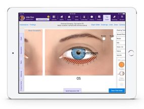 EMA Interactive Anatomical Atlas external view of ectropion OS