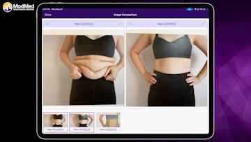 Cool Sculpting With ModMed® Plastic Surgery