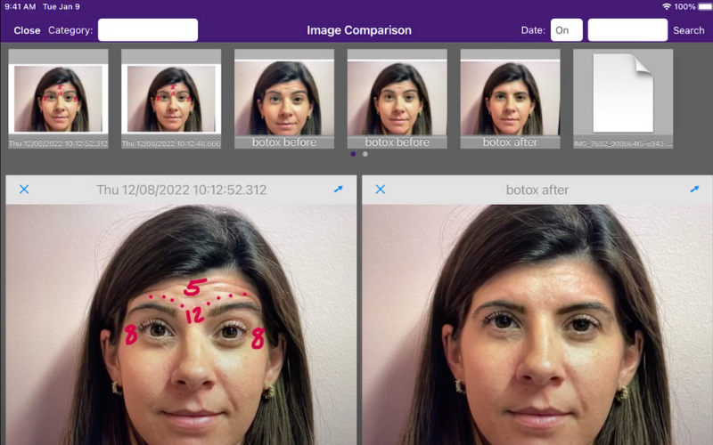 Before and After Images Image showing botox before and after pictures.